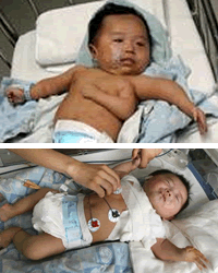 Extirpan Con Exito El Tercer Brazo De Un Bebe Chino De Dos Meses De Edad Ideal